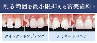 削る範囲を最小限抑えた審美歯科