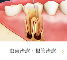 虫歯治療・根管治療