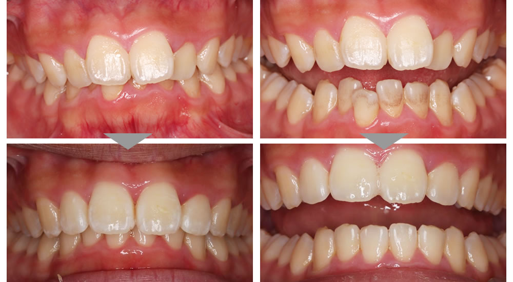 前歯の矯正治療症例
