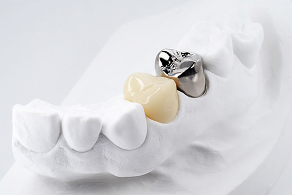 保険適用の白い歯