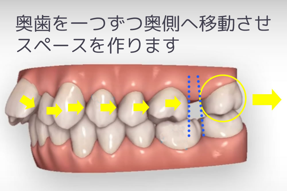 奥歯の遠心移動