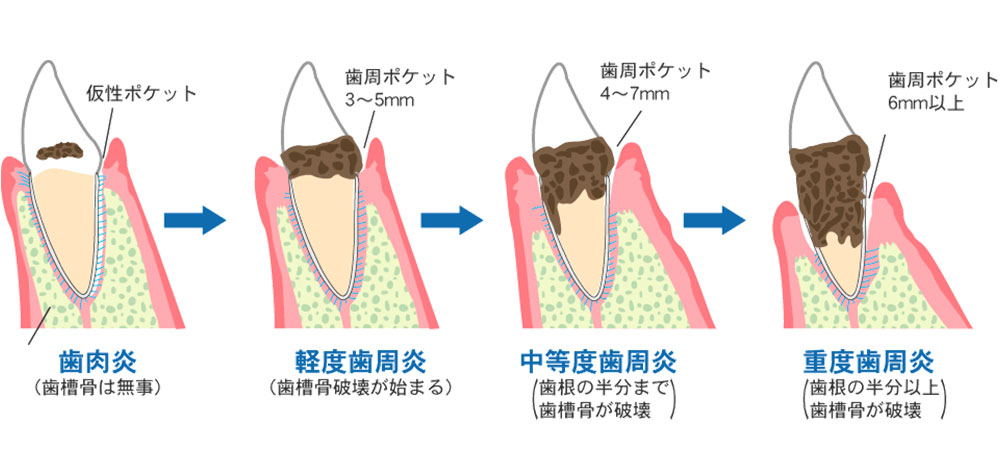 歯周病の早期発見