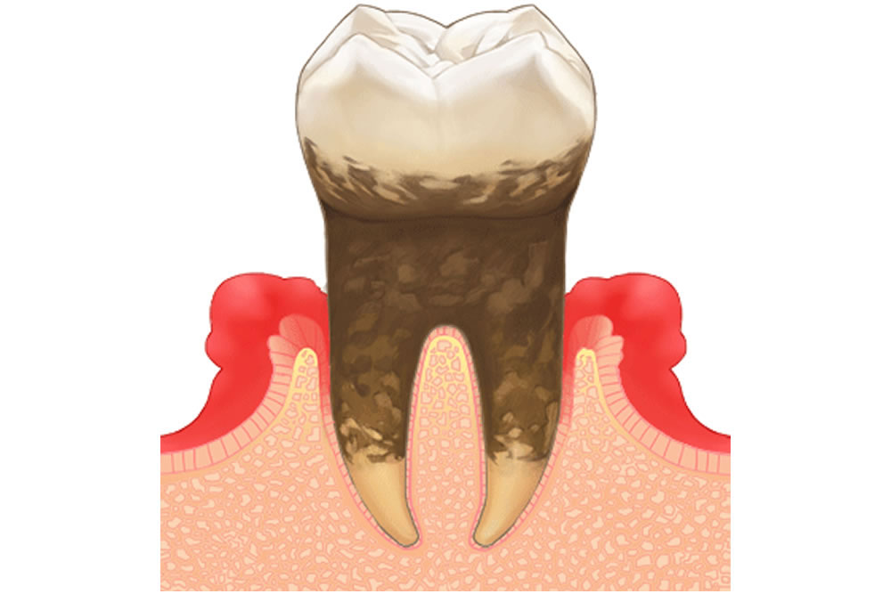 歯周病
